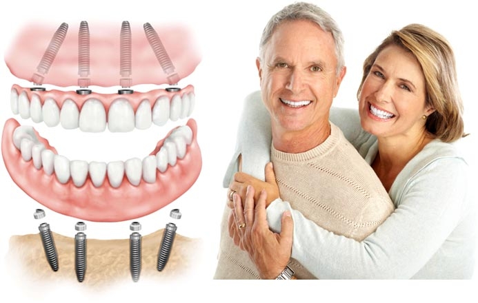 All on Four Dental Implants: A Comprehensive Guide
