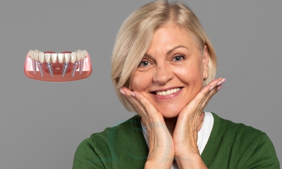 All On 6 Dental Implants