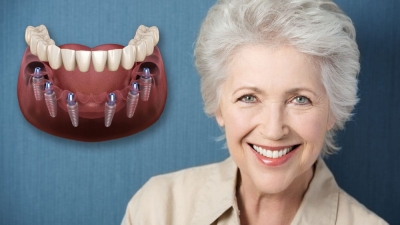 All About Dental Implants and Their Life-Changing Benefits