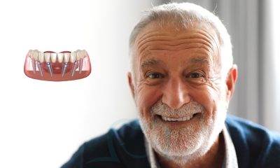 Dental Implants in Turkey: Key Benefits and FAQs